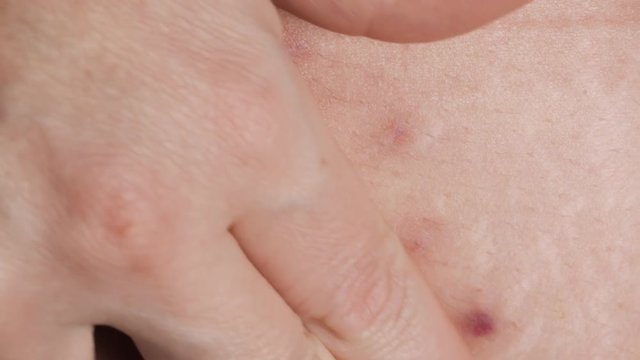 Woman showing the stomach with a appendicitis scar after surgery. Scar removal