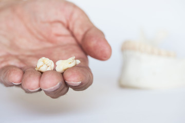 Two extracted wisdom teeth on dentist palm.