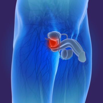 3D illustration of prostate cancer