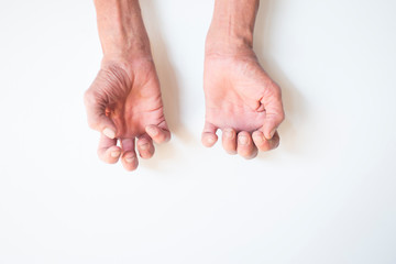 Trigger Finger a defect in a tendon causing a finger to jerk or snap straight when the hand is extended.