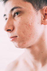 Man with problematic skin and scars from acne