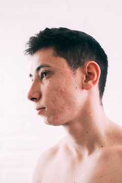 Man with problematic skin and scars from acne
