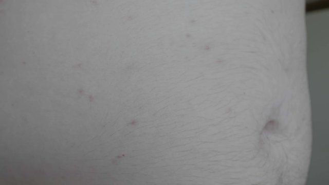 Closeup of adult man belly with skin allergy reaction caused by mosquito or insects bites