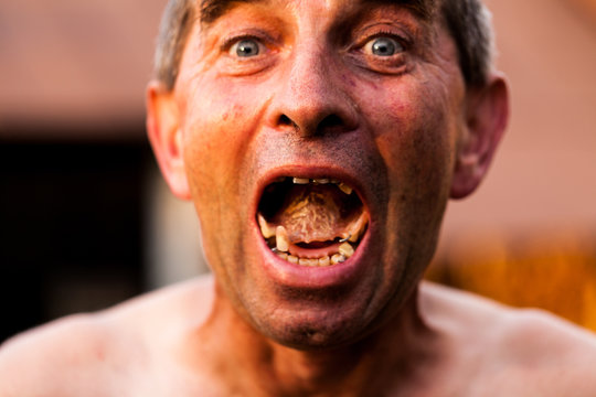 Close up of an old man showing ugly dentures. Tooth decay building up in a wide open mouth. Poor personal hygiene and maintenance. Unhealthy teeth concept
