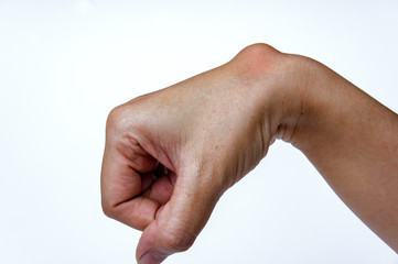 Ganglion cyst on woman hand on white background