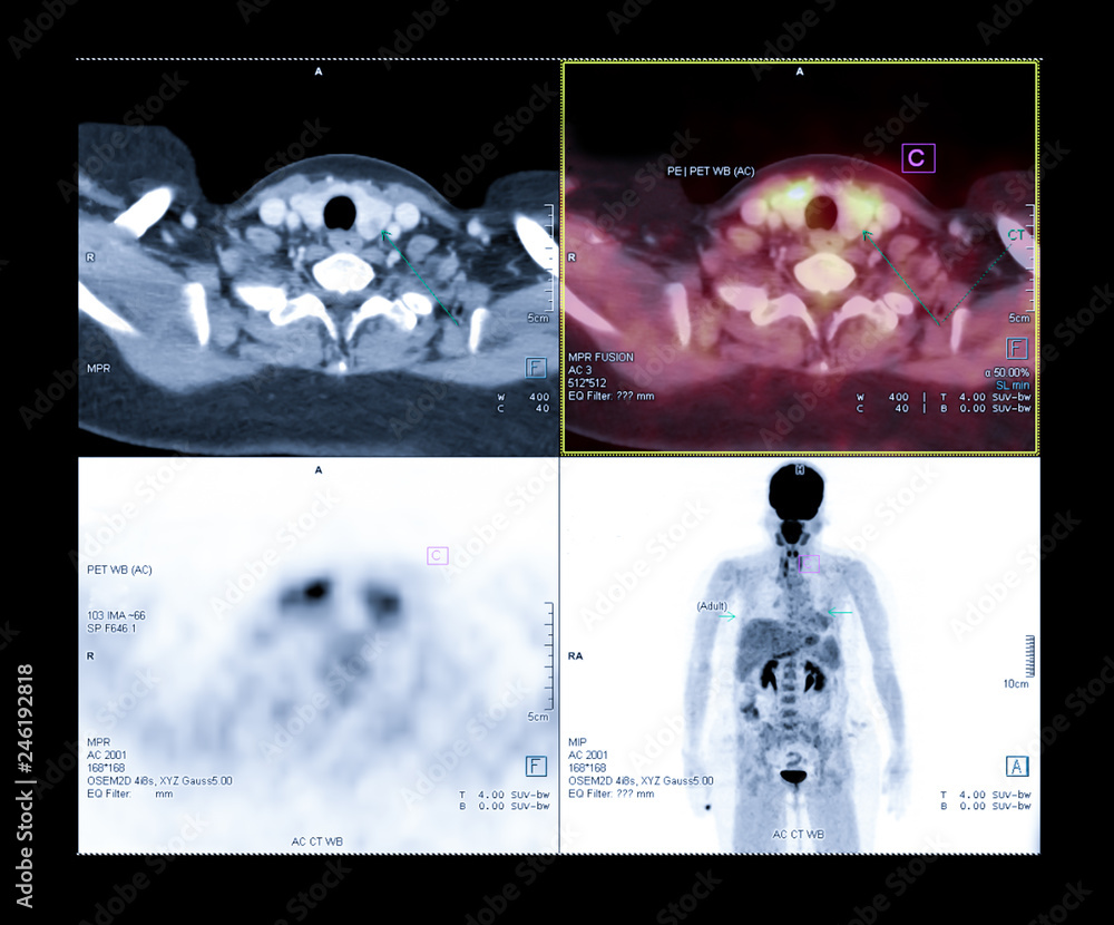 Poster pet scan image of the neck or thyroid gland comparison ct scan image vs pet ct for detect cancer.