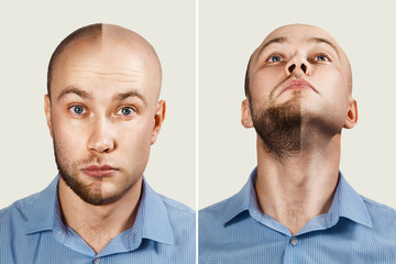 two Man before and after hair loss, alopecia on background. concept of baldness: the first man photo in front, the second - chin up