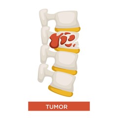 Bone tumor skeleton disease or cancer medicine