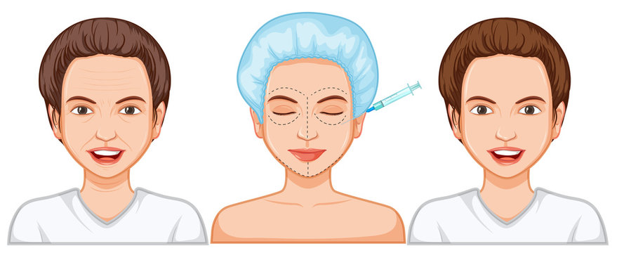 Comparison of female botox injection