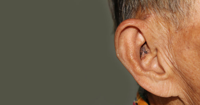 An Elderly Asian Man Has A Black Stigma In His Ear.