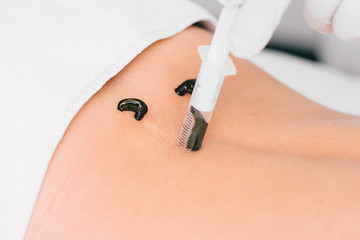 Hirudotherapy procedure. The doctor holds the leech, close-up, applying leech it to the patient's...