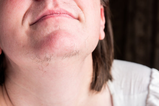 Woman With Hairs On Chin. Hair Removal On Face.