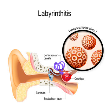 Labyrinthitis. inflammation of the inner ear and Herpes simplex virus that caused this disease