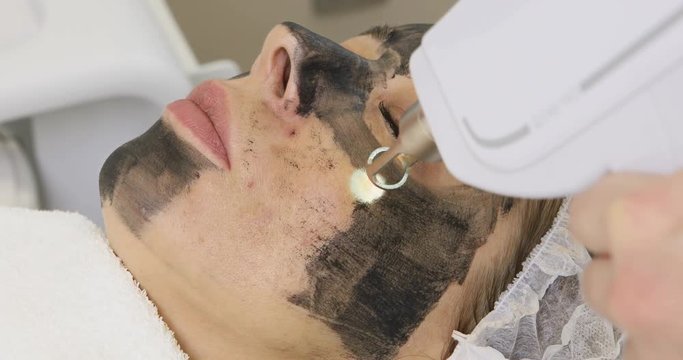Close-up of carbon peeling procedure for adult woman. Laser rejuvenation and clean skin of the face.