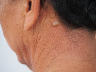 Neck is sebaceous cyst on white background.