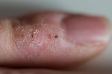 Closeup of fissures in a finger on a white background. The pinky finger was compulsively bitten due to nervousness