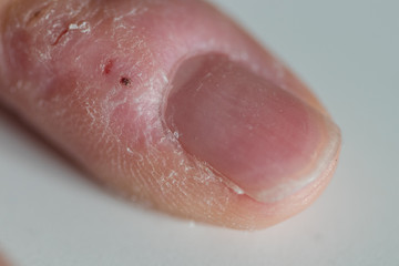 Macro shot of fissures in a finger on a white background. The pinky finger was compulsively bitten due to nervousness