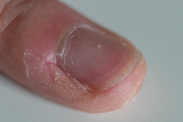 Obraz premium Closeup of a nail surrounded by fissures on a white background. The pinky finger was compulsively bitten due to nervousness