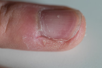 Macro shot of finger injuries on a white background. The pinky finger was compulsively bitten due to nervousness