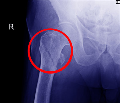 Hip fracture xray photo image. X-ray of hip joint for elderly patient who falling in the house