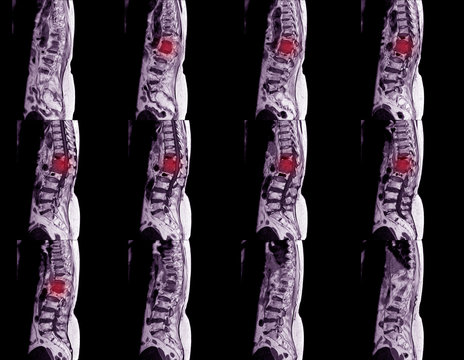 MRI Of Lumbar Spine With Contrast