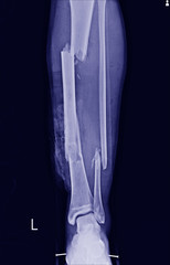 Multiple fracture leg tibia and fibular