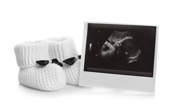 Ultrasound photo and baby shoes on white background. Concept of pregnancy