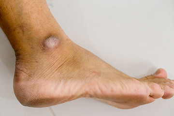 Closed-up of a dry and cracked heel, crack heel on white background