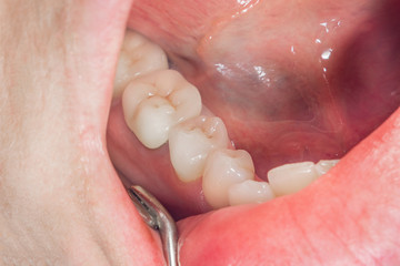 dental restoration of rotten roots of the teeth with ceramic crowns. cast posts dentistry