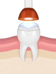 3d render of tooth with dental polymerization lamp and light cured onlay