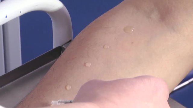 Allergy - skin prick tests, cute girl in a laboratory. Skin test for allergens.