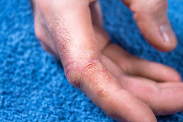 Twardy, zrogowaciały i popękany naskórek na palcu w męskiej dłoni. Łuszczyca, uczulenie, alergia,