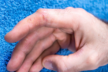 Popękana, łuszcząca się skóra na dłoni. Problemy dermatologiczne łuszczyca. Twardy, zrogowaciały i popękany naskórek na palcu w męskiej dłoni. Łuszczyca, uczulenie, alergia,