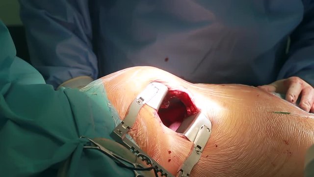 Medical team of surgeons in hospital doing minimal invasive surgical interventions. Surgery operating room with electrocautery equipment for cardiovascular emergency surgery center.