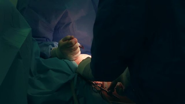 Medical team of surgeons in hospital doing minimal invasive surgical interventions. Surgery operating room with electrocautery equipment for cardiovascular emergency surgery center.