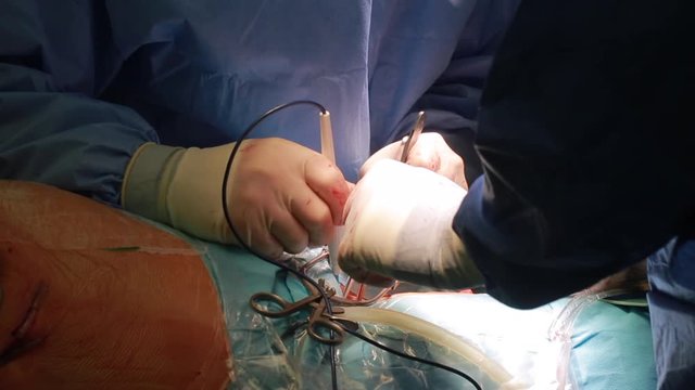Cardiovascular surgery doctor in surgery center for interventions with instruments in surgeon operation electrosurgery with thoracotomy microsurgery doing minimal invasive open heart surgery