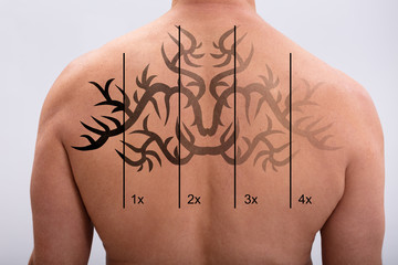 Laser Tattoo Removal On Man's Back