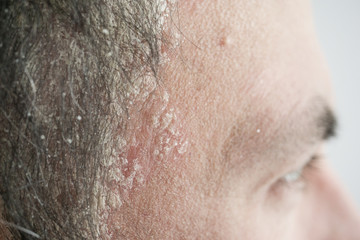 psoriasis on the hairline and on the scalp-close up, dermatological diseases, skin problems