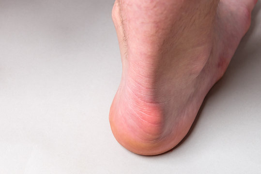 Bump On The Back Of Heel Bone Called Haglund's Deformity On Gray Background.