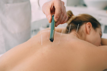 Acupuncturist inserting a needle into a female back. patient having traditional Chinese treatment...