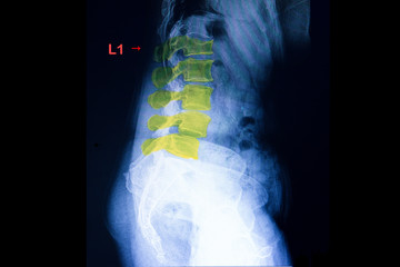 compression fracture of lambar spine
