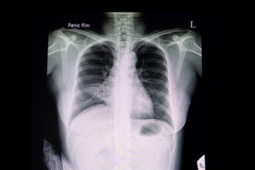 A patient with pneumonia