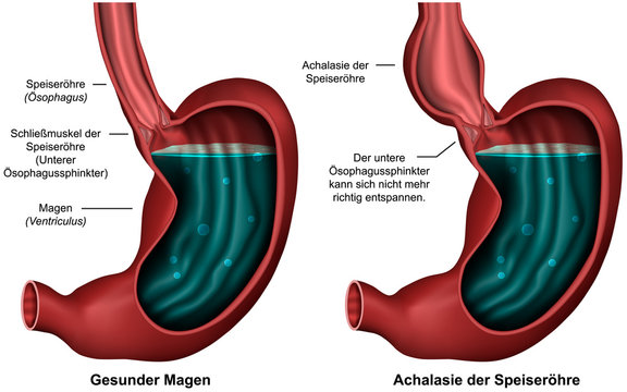 Achalasie der Speiseröhre, Illustration