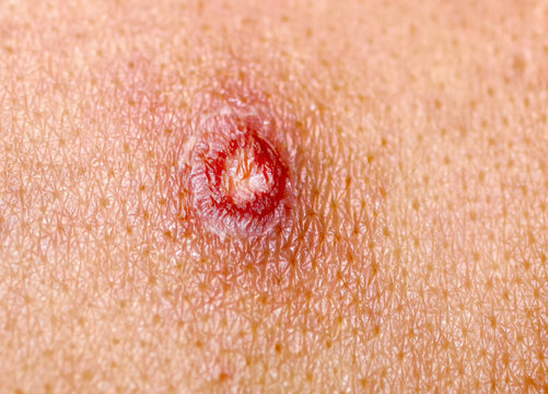 Ulcer on the skin. Smallpox. A wound, an abrasion, a cut, a scab. Chickenpox.