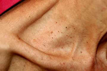 Neck and collarbone in papillomas. Papilloma on the skin.