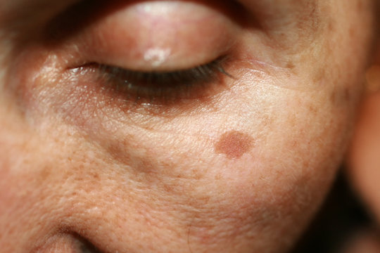 Pigmentation on the face. Brown spot on cheek. Pigment spot on the skin.