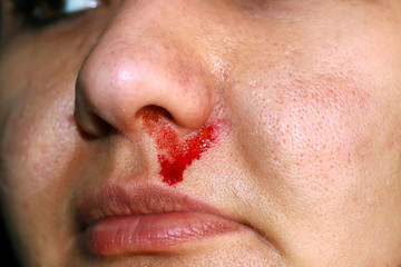 Violence in family. Blood from the nose of a woman. Beating