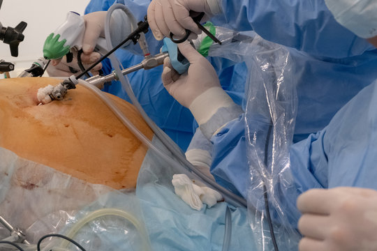 Endo Bilder Durchsuchen 556 Archivfotos, und Videos