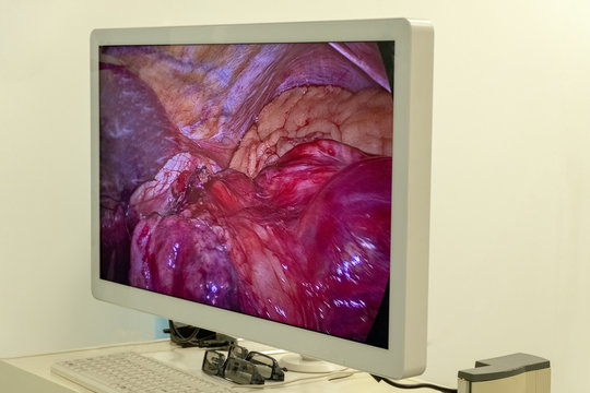 Image Of The Operation Process Inside The Patient's Abdomen On The Monitor Or High-definition TV. The Work Of Surgeons Using Endovideo Of Surgical Instruments. Laparoscopy. Close-up Endoscopy Hospital