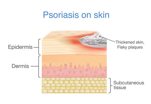Illustration of human skin layer when plaque psoriasis signs and symptoms appear.
